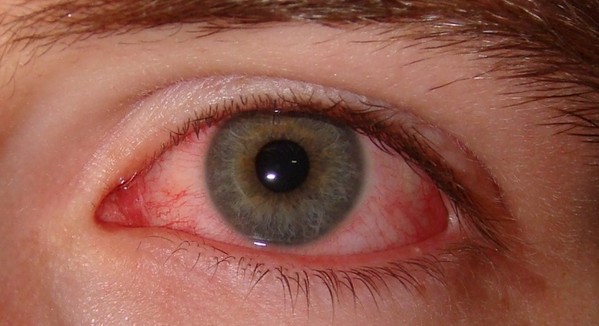 воспаление глаз